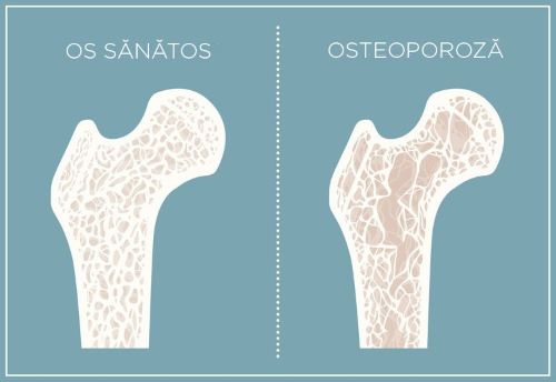 Osteoporoza: Ce este? Simptome si Tratament